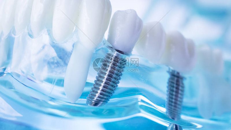 成都隐形矫正，2025价格背后的考量因素
